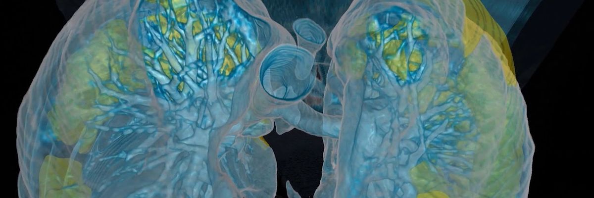 A Virtual Reality Look at a COVID-19 Patient's Lungs: No 'MD' Needed to Read These Scans