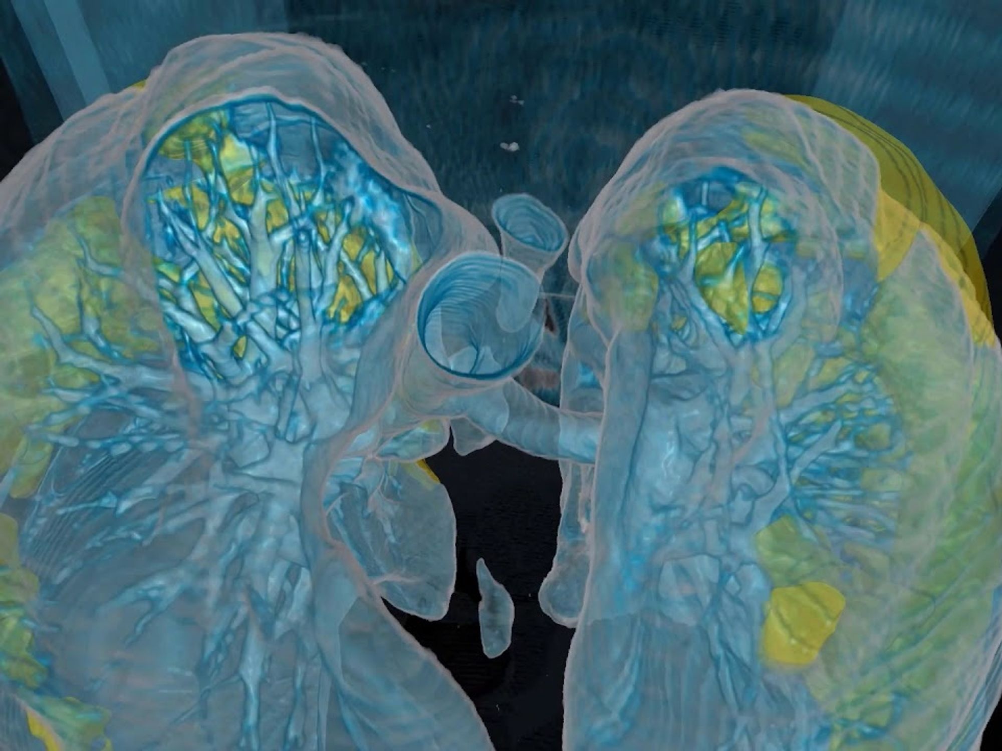 A Virtual Reality Look at a COVID-19 Patient's Lungs: No 'MD' Needed to Read These Scans