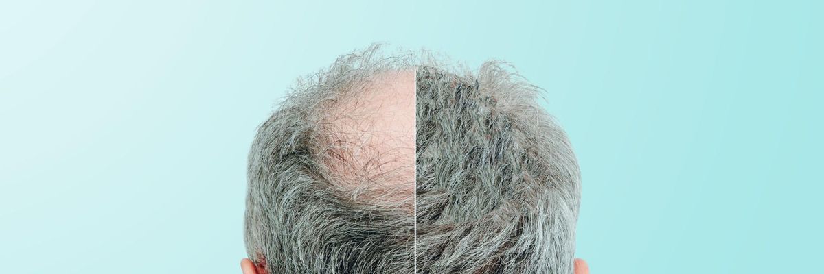 Southern California Grows Roots as Potential Hotspot For Hair Loss Therapies