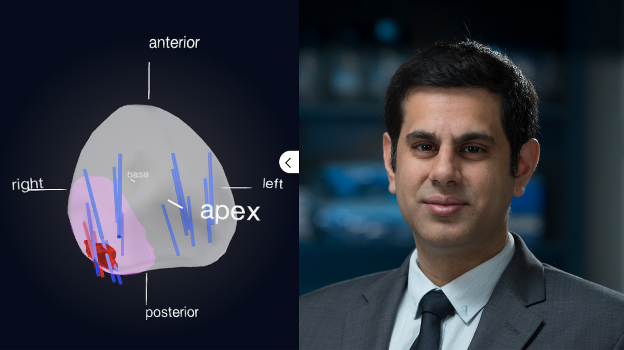 Avenda Health's AI-Powered Tech Is a Game-Changer in Early Prostate Cancer Detection